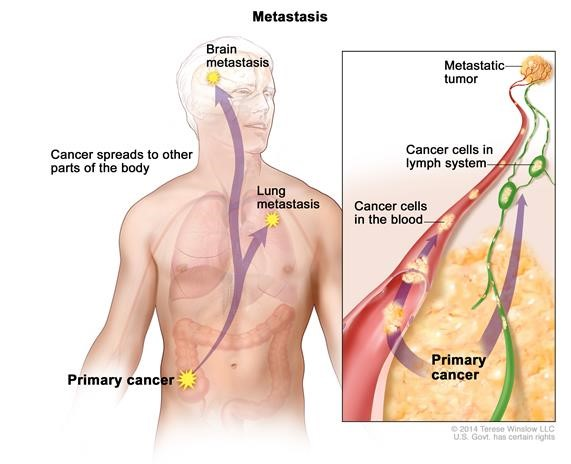 cancer-metastasis-causes-symptoms-and-metastasis-survival-rate